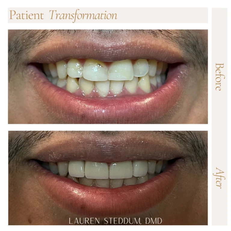 before and after dental transformation photo from Steddum Dentistry