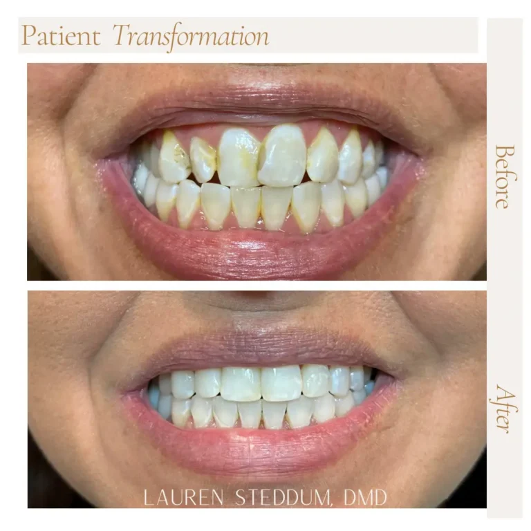 before and after dental transformation photo from Steddum Dentistry