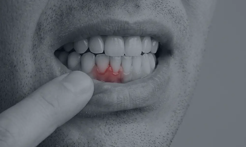 Gum Disease Treatment in Raleigh